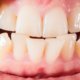 What Causes Crooked Teeth | Shinagawa Dental Blog