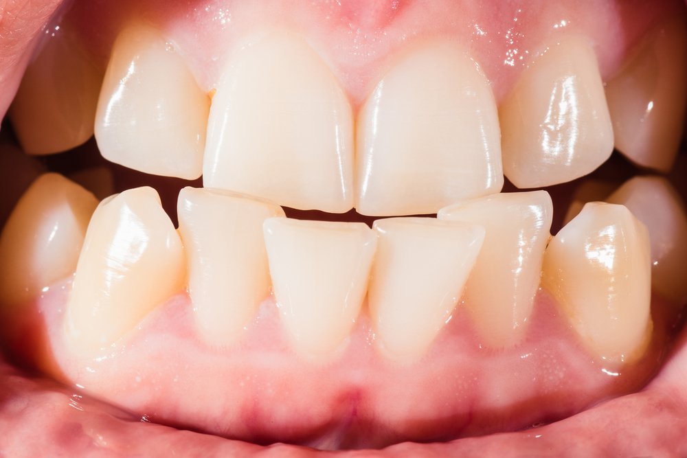 Causes Of Crooked Teeth Shinagawa Dental Blog