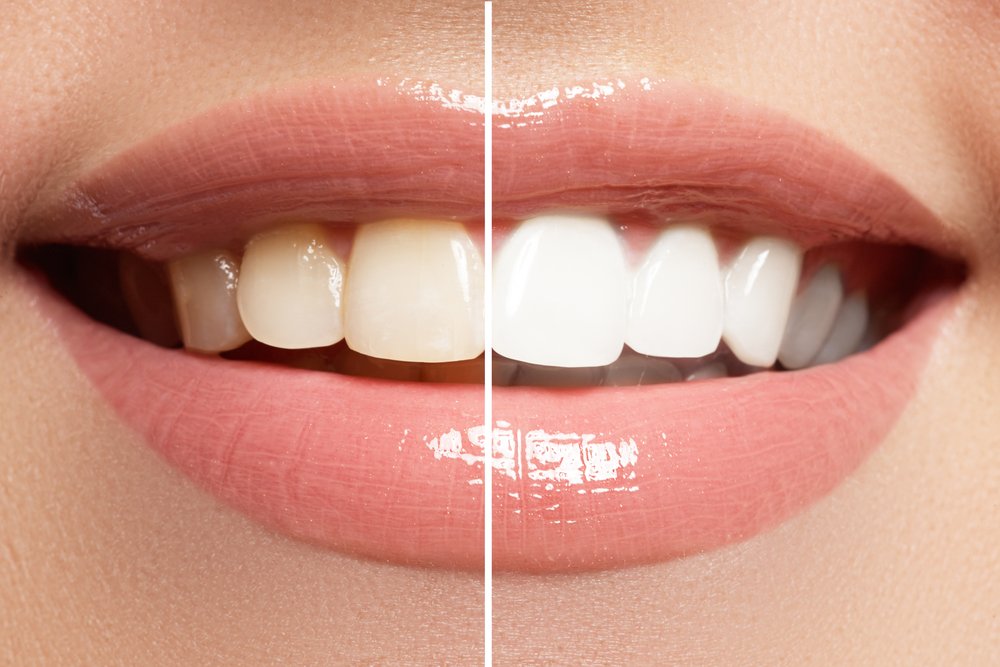 What You Need To Know About Teeth Whitening | Shinagawa Dental Care