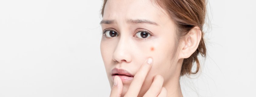 The Difference Between Dry And Oily Acne | Shinagawa Aesthetics Blog