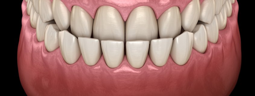 Underbite Explanation | Shinagawa Dental Blog