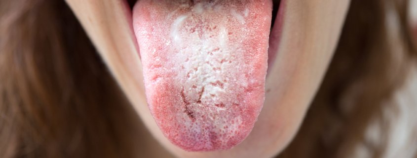 Problems With Your Tongue | Shinagawa Dental Blog