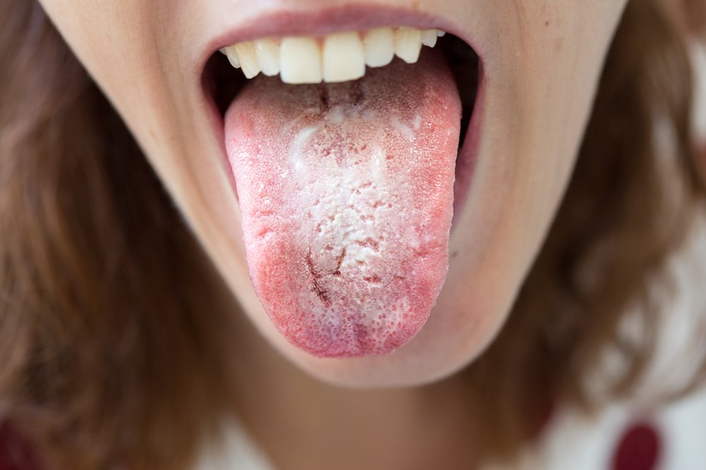 Problems With Your Tongue | Shinagawa Dental Blog