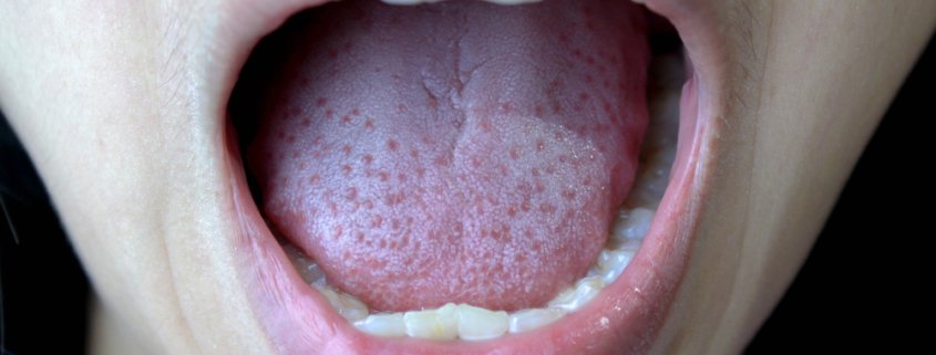 Treating Your White Tongue Properly | Shinagawa Dental Blog