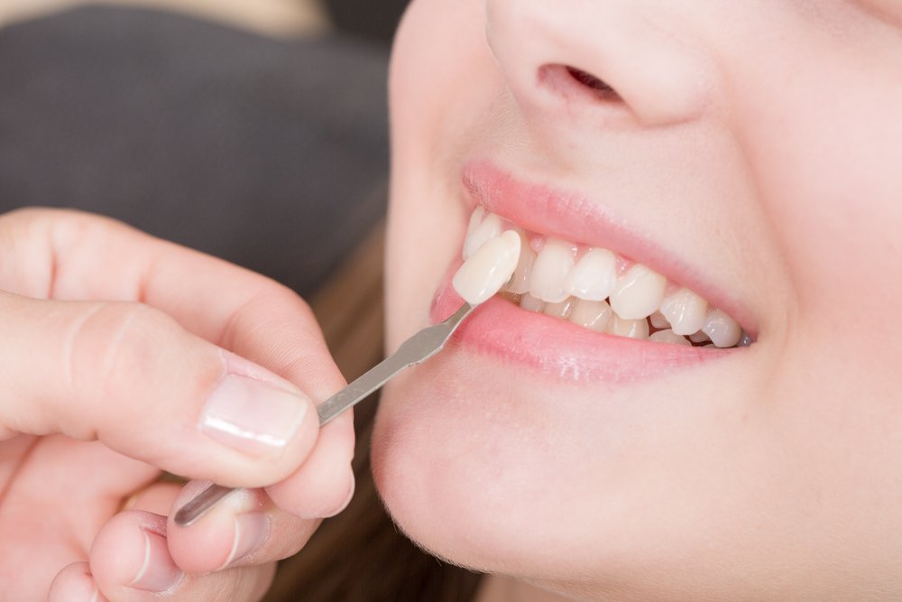 Veneers — Your Solution For A Better Smile | Shinagawa Dental Blog