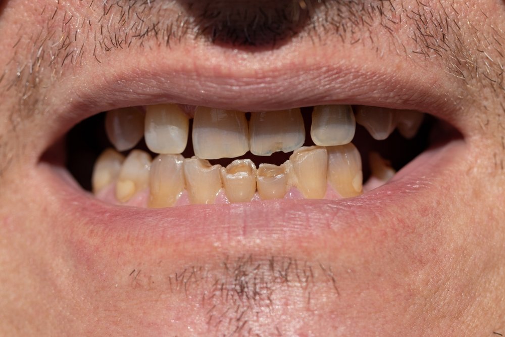Difference Between A Chipped Tooth And Cracked Tooth | Shinagawa Dental Blog