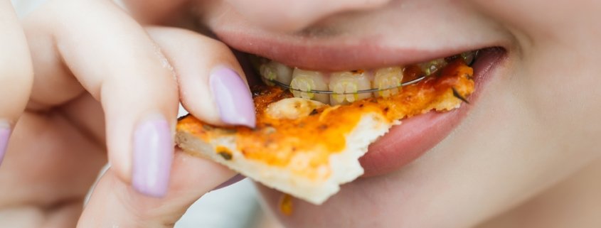 Foods To Avoid And Eat With Braces | Shinagawa Dental Blog