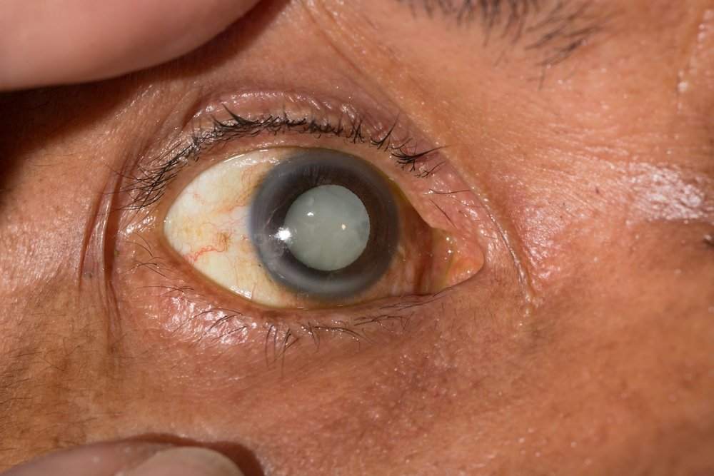 Slowing Down Cataract Progression | Shinagawa Cataract Blog