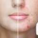 Facial Scars Treatment Laser Resurfacing | Shinagawa Blog