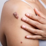 Getting Rid Of Your Warts, Moles And Keloids | Shinagawa Blog