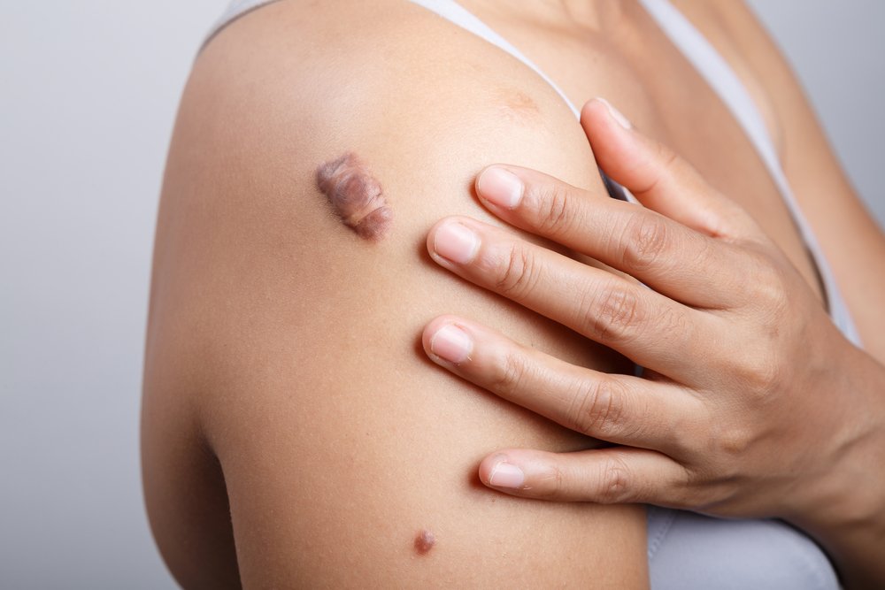 Getting Rid Of Your Warts, Moles And Keloids | Shinagawa Blog