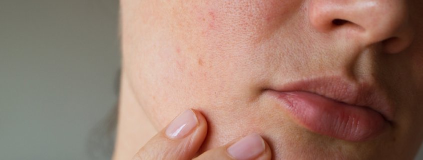 Did Quarantine Give You Acne And Dry Skin? | Shinagawa Blog