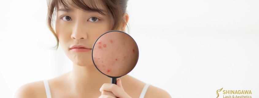 Why Is Your Acne Getting Worse In Quarantine | Shinagawa Blog