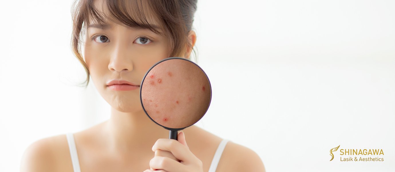 Why Is Your Acne Getting Worse In Quarantine | Shinagawa Blog