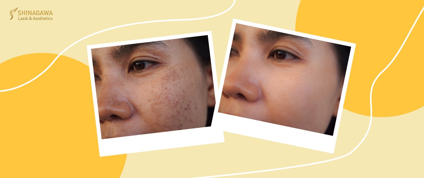 How Can We Fade Acne Scars & Hyperpigmentation? | Shinagawa Blog