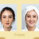 Worried About Hyperpigmentation? | Shinagawa Blog