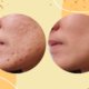 The Objectives Of Laser Treatments For Acne And Acne Scars | Shinagawa Blog