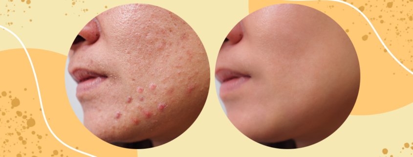 The Objectives Of Laser Treatments For Acne And Acne Scars | Shinagawa Blog