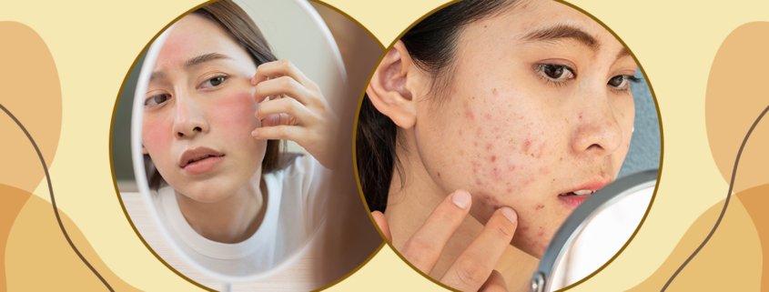 Skin Breakouts vs. Skin Purging | Shinagawa Blog