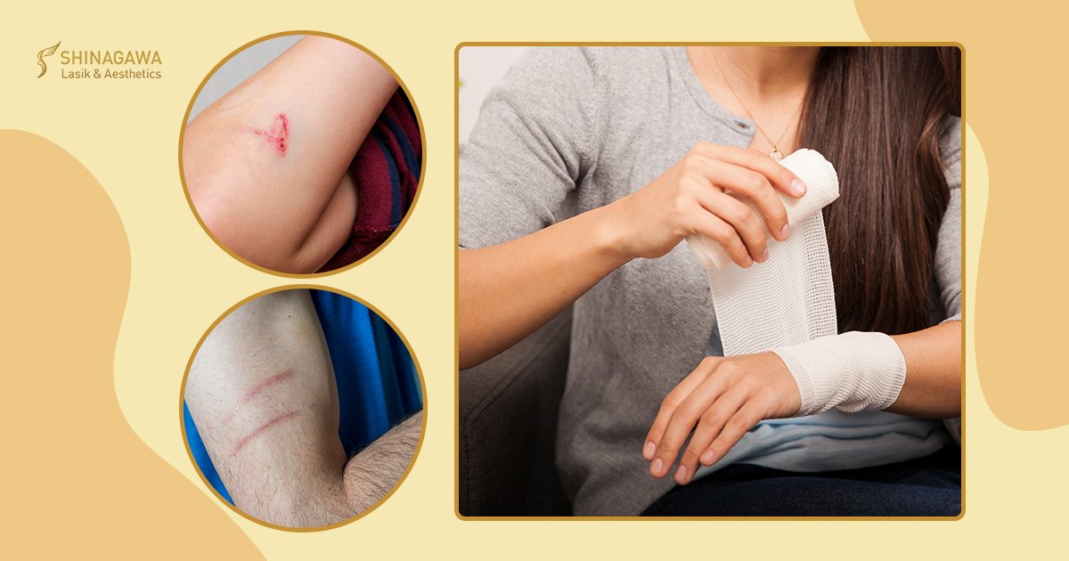 The Best Way To Prevent Scarring | Shinagawa Blog