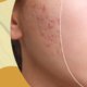 This Is How You Can Fade Acne Scars | Shinagawa Blog