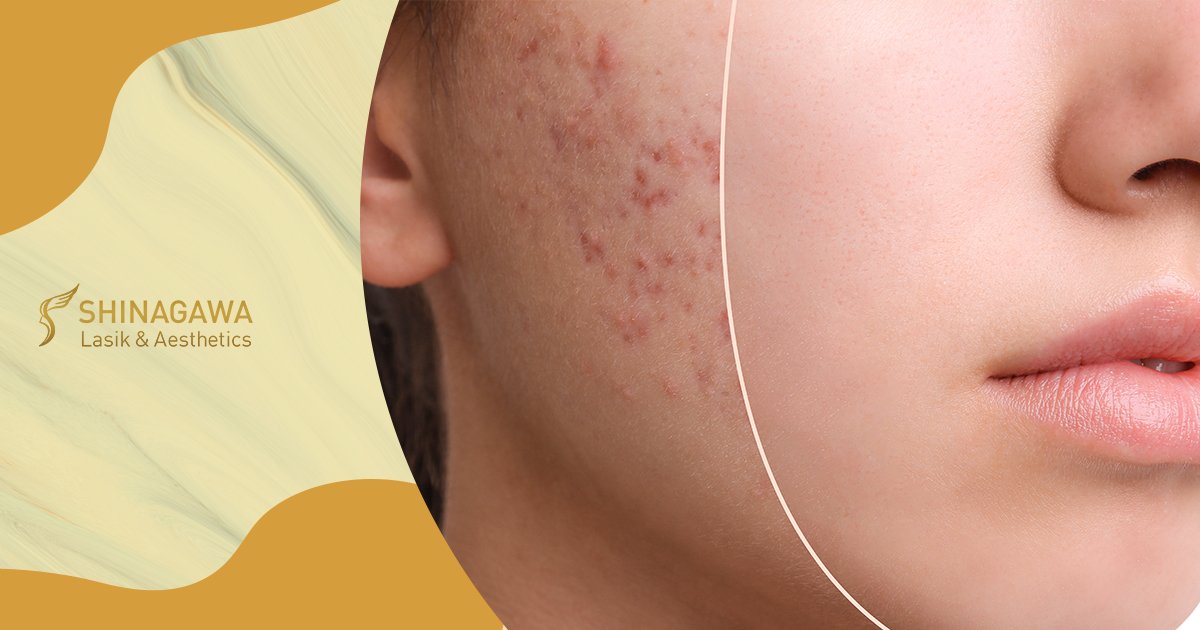 What light fades acne scars?