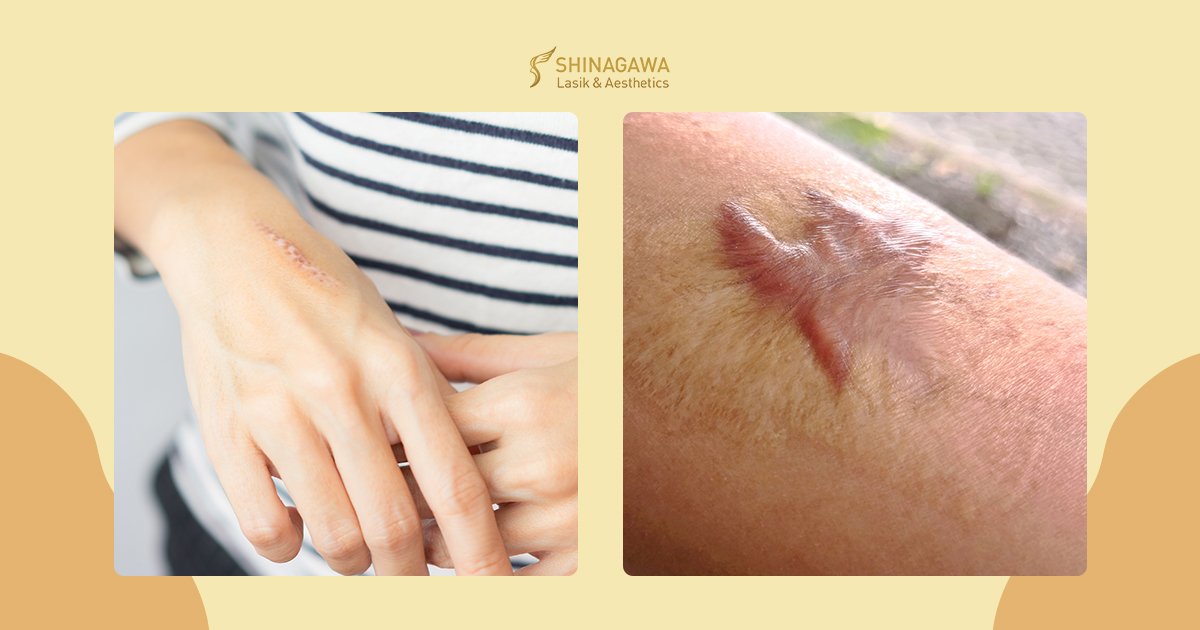 Types Of Scars | Shinagawa Blog