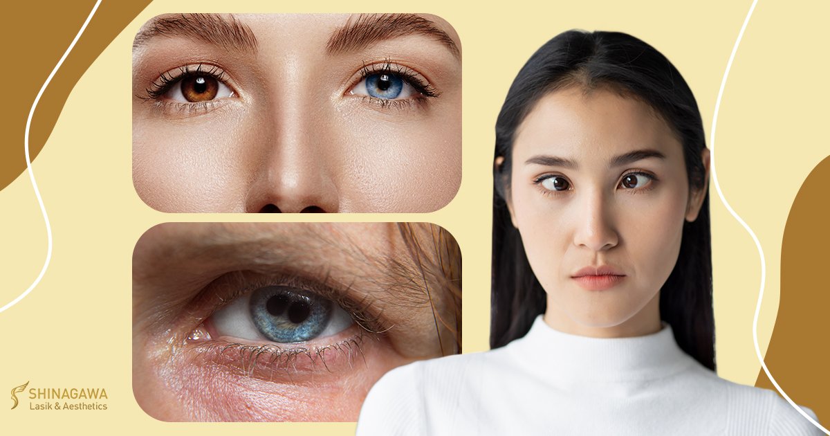Knowing Rare And Bizarre Eye Conditions | Shinagawa Blog