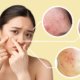 The Different Types Of Acne | Shinagawa Blog