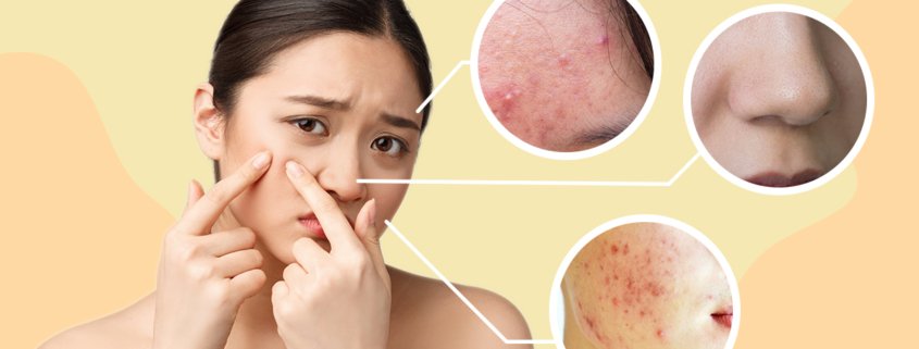 The Different Types Of Acne | Shinagawa Blog