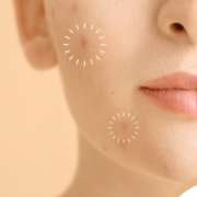 Ways To Get Rid Of Acne Scars | Shinagawa Blog