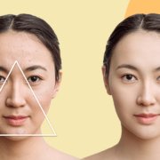 What Is The ‘Danger Triangle Of The Face’? | Shinagawa Blog