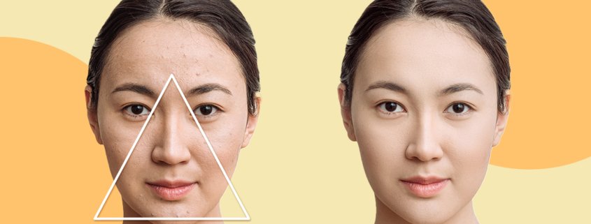What Is The ‘Danger Triangle Of The Face’? | Shinagawa Blog