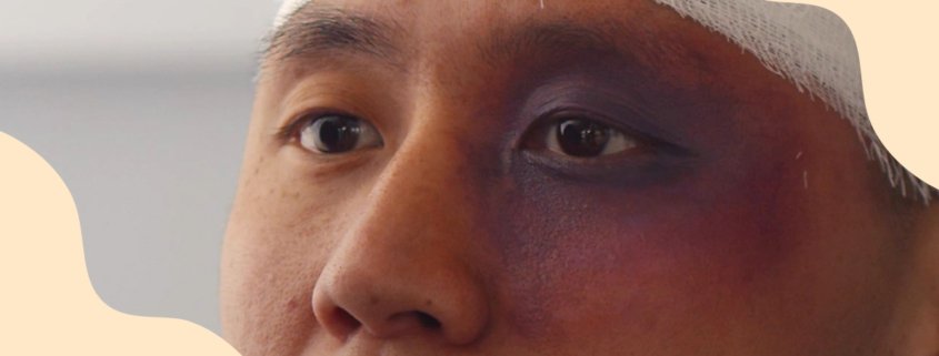 Ways To Fade A Black Eye | Shinagawa Blog