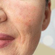 acne in 50s