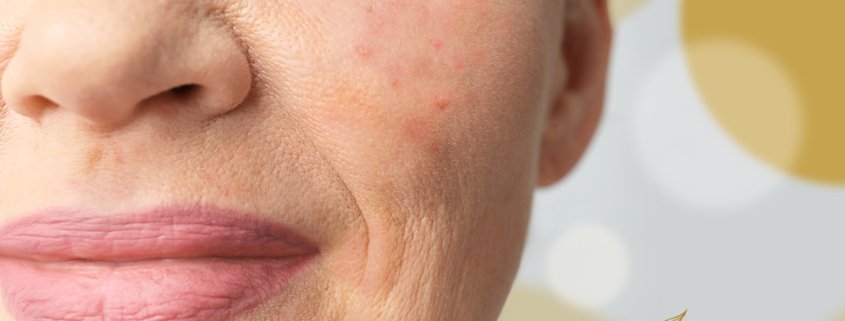 acne in 50s