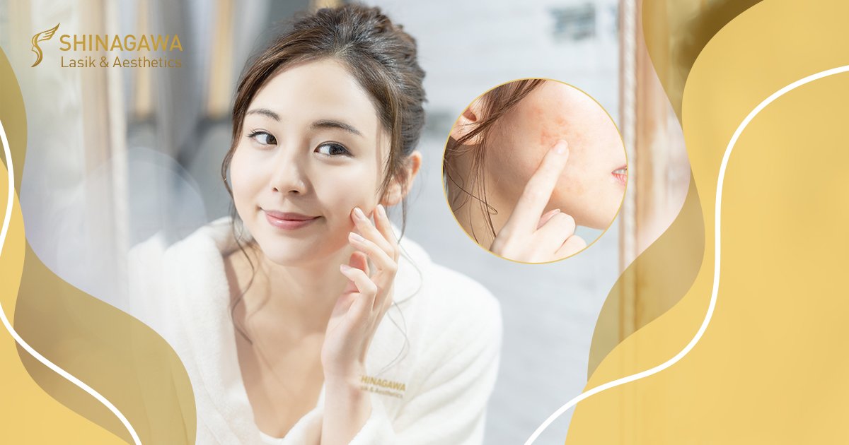 It’s Never Too Late To Treat Those Acne Scars | Shinagawa Blog