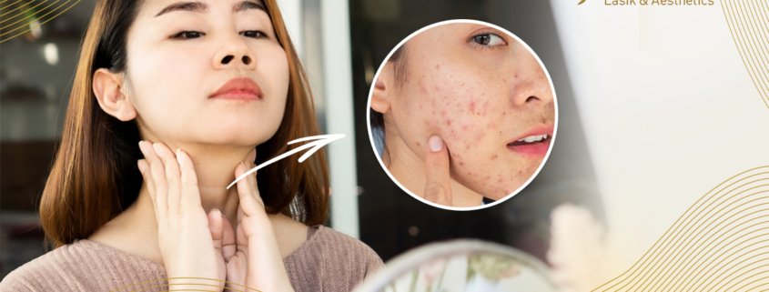 Are Thyroid Issues Causing Your Acne