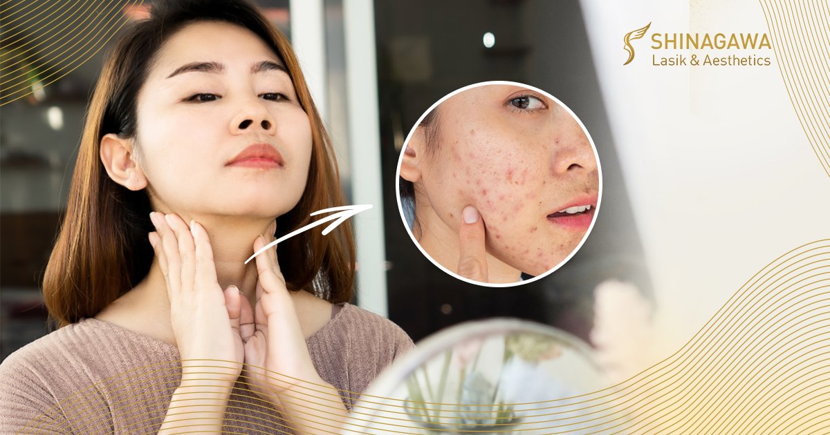 Are Thyroid Issues Causing Your Acne