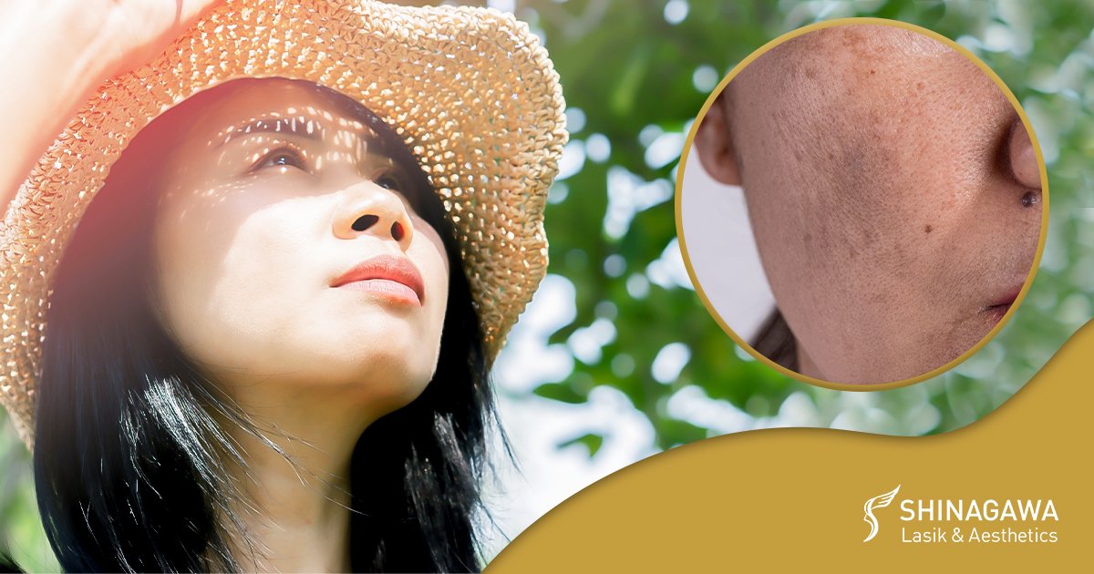 The Thing About Melasma