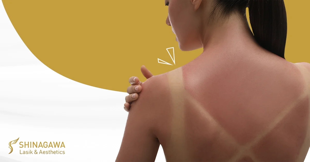What happens when you get a sunburn