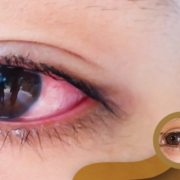 Complications and Management of Eye Infections
