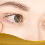 Woman checking red irritated eye, showing symptoms of allergic conjunctivitis or eye infection.