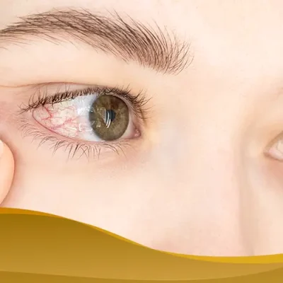 Woman checking red irritated eye, showing symptoms of allergic conjunctivitis or eye infection.