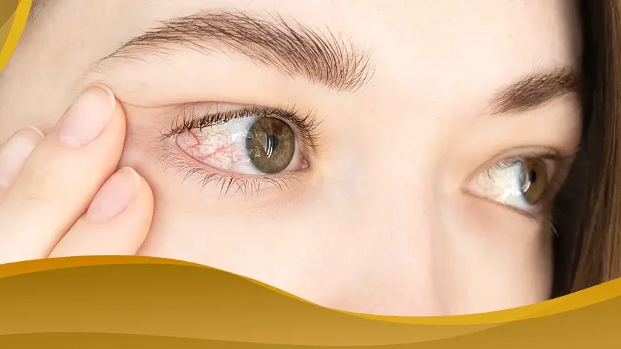 Woman checking red irritated eye, showing symptoms of allergic conjunctivitis or eye infection.