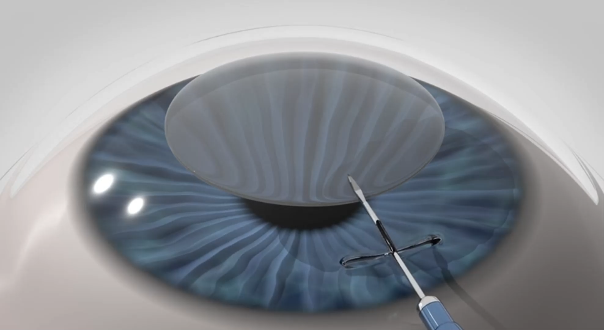 <br>The Laser the produces a small tunnel in the cornea
