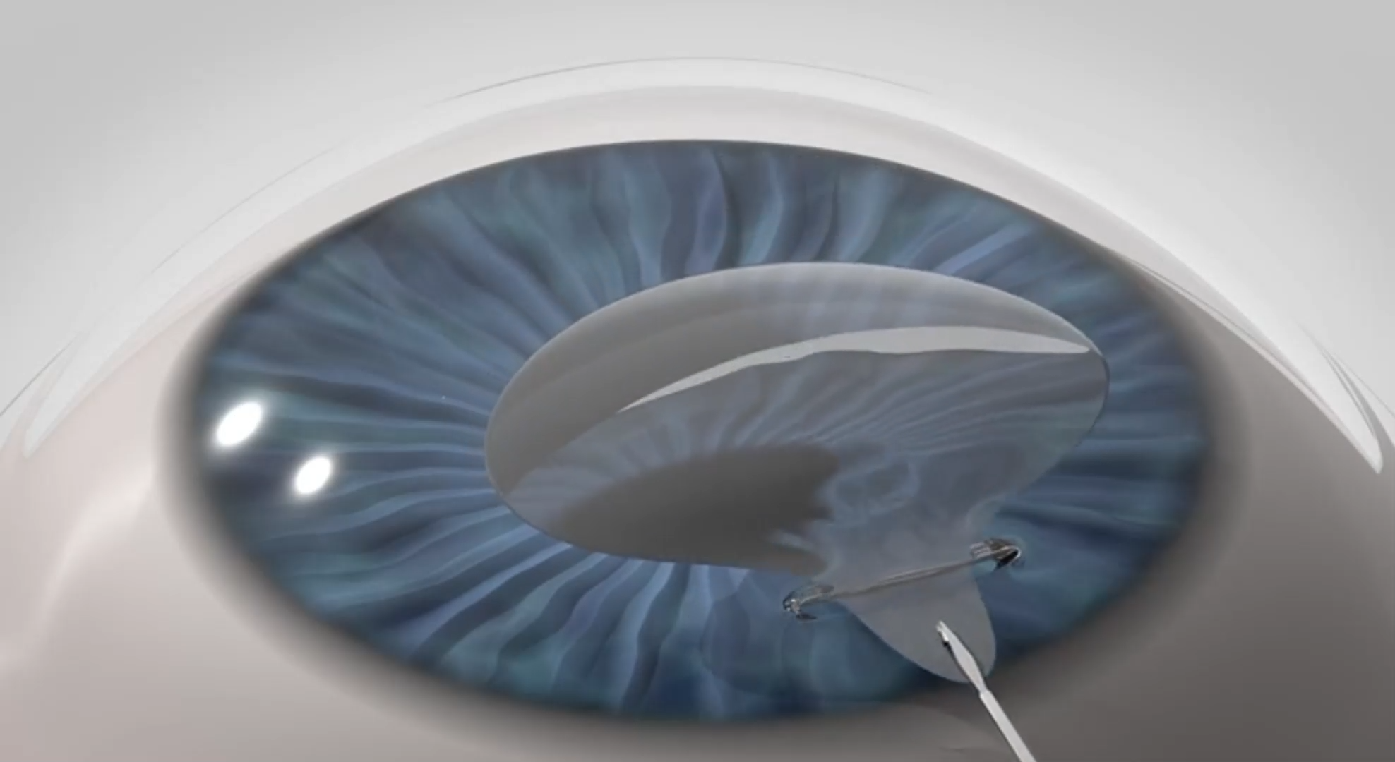 <br>The surgeon gently removes the lenticule through a small incision.