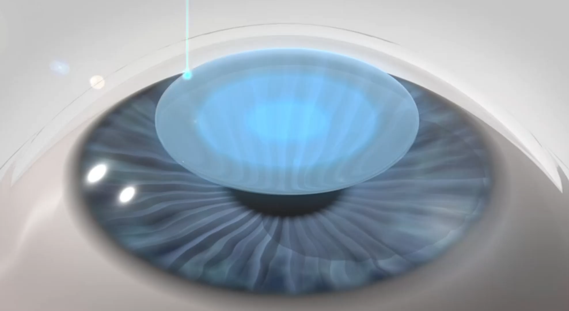 <br>FEMTO LDV Z8 laser directs a series of pulses at the cornea. These pulses form bubbles which outline small clear lens (Lenticule).