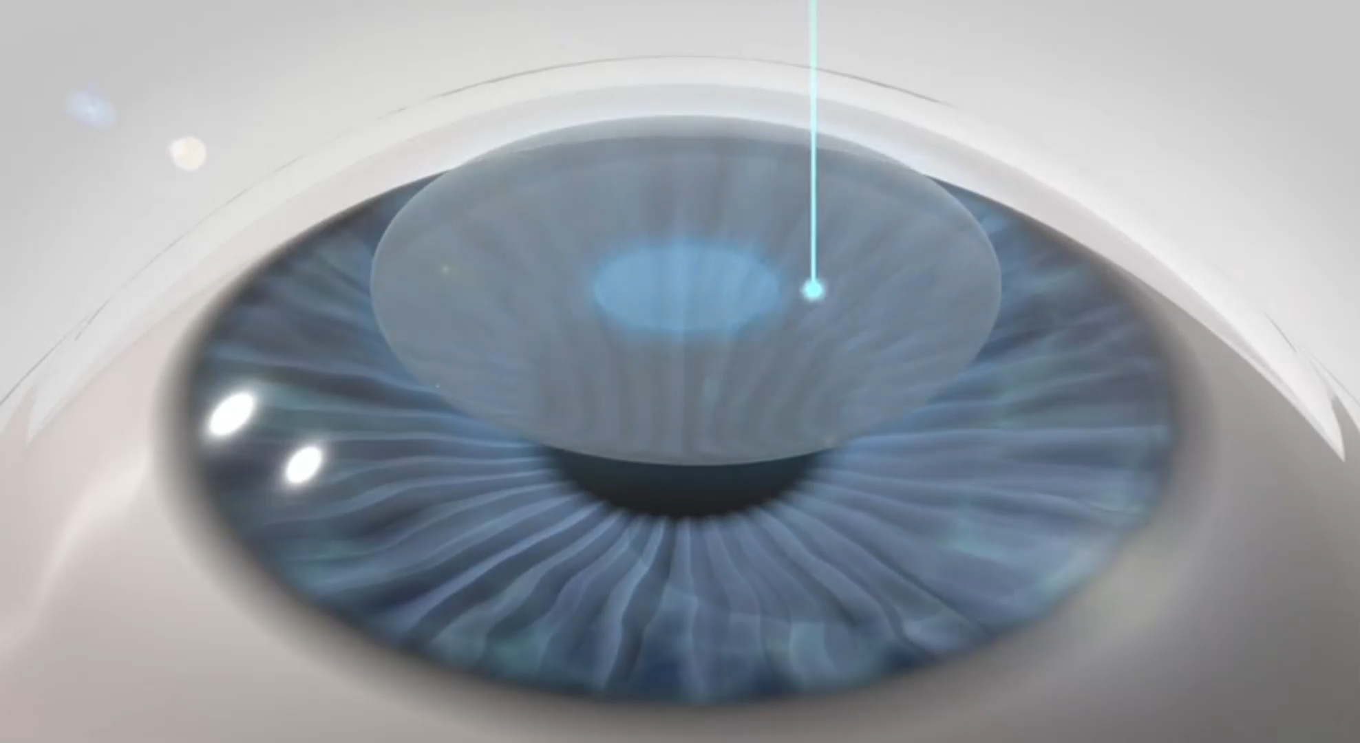 <br>Local anesthetic eye drops are applied to both eyes.