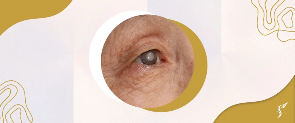 Corrective Options to Improve Vision